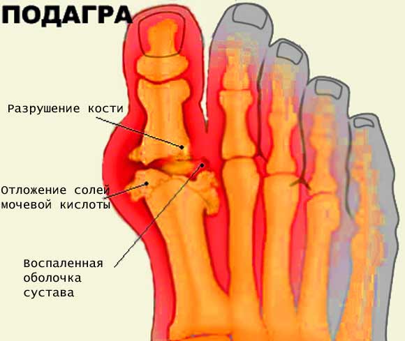 simptomy-podagry