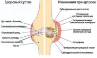 izmeneniya-pri-artroze