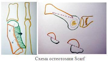 Схема вмешательства