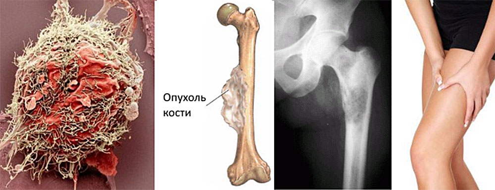 Опухоль костной ткани