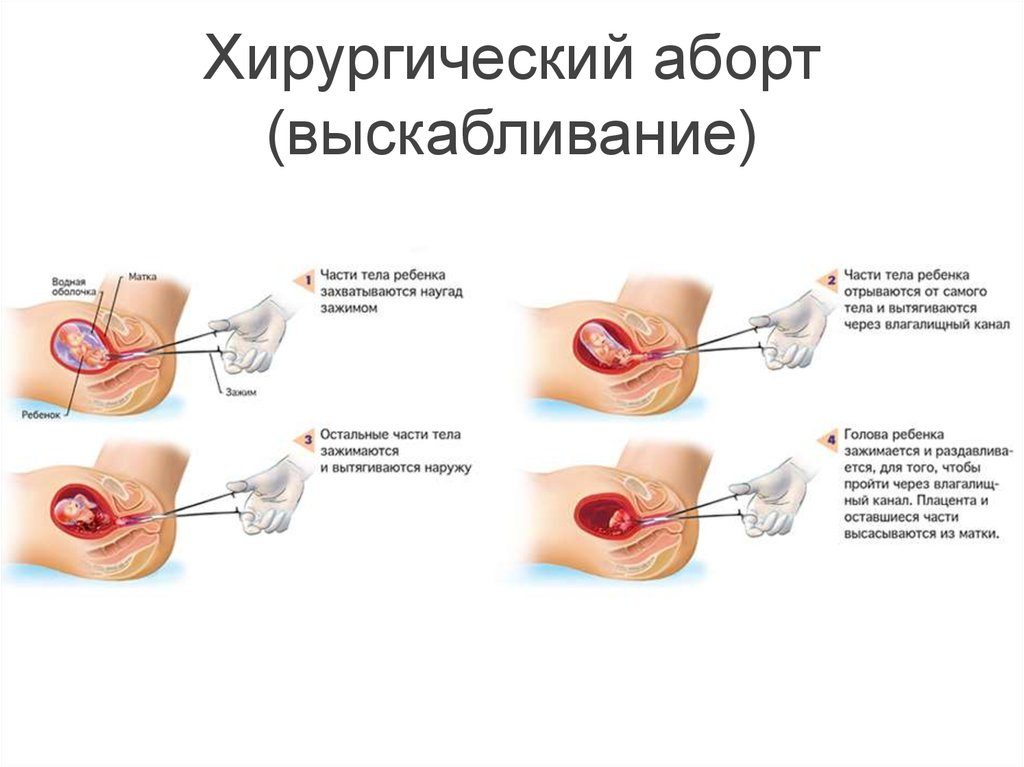 Частые аборты в прошлом могут не позволить эмбриону развиваться в будущем