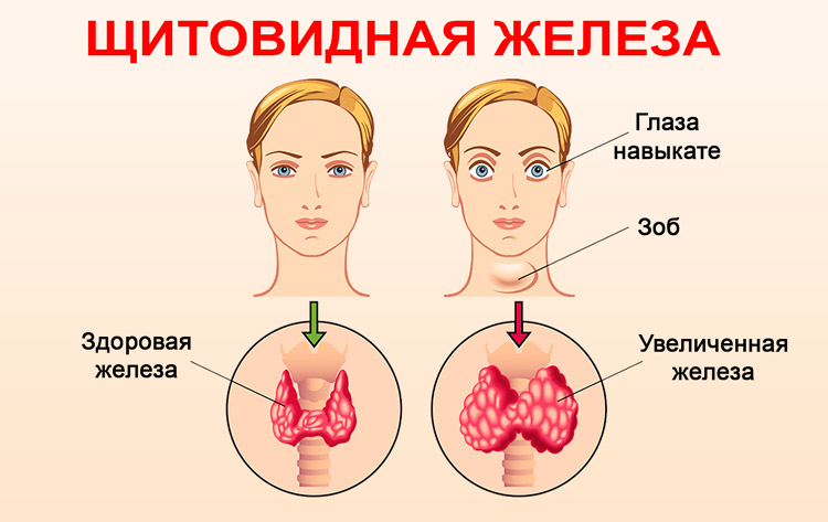 Дисфункция щитовидной железы выступает причиной замершей беременности