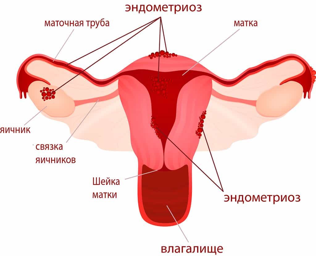 Локализация патологических очагов при эндометриозе