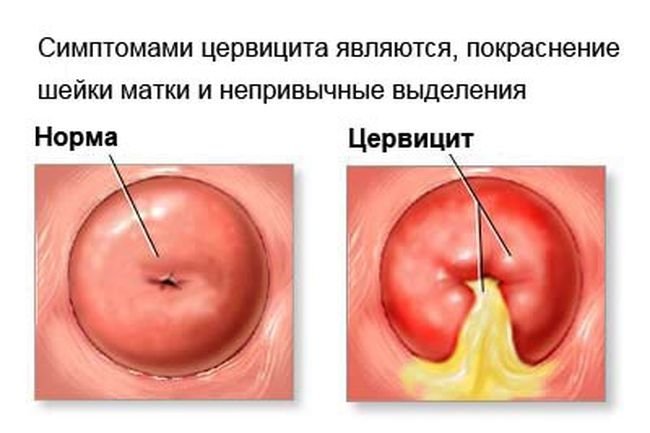 Средство эффективно использовать для борьбы с цервицитом